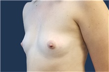 Breast Augmentation Before Photo by Noel Natoli, MD, FACS; East Hills, NY - Case 43311