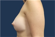 Breast Augmentation After Photo by Noel Natoli, MD, FACS; East Hills, NY - Case 43311