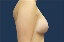 Breast Augmentation After Photo by Noel Natoli, MD, FACS; East Hills, NY - Case 43311