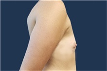 Breast Augmentation Before Photo by Noel Natoli, MD, FACS; East Hills, NY - Case 43311