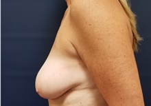 Breast Reconstruction Before Photo by Noel Natoli, MD, FACS; East Hills, NY - Case 43312