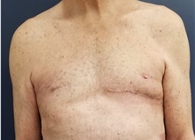 Breast Reconstruction After Photo by Noel Natoli, MD, FACS; East Hills, NY - Case 43321