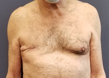 Breast Reconstruction Before Photo by Noel Natoli, MD, FACS; East Hills, NY - Case 43321