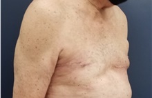 Breast Reconstruction After Photo by Noel Natoli, MD, FACS; East Hills, NY - Case 43321