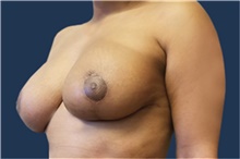 Breast Reconstruction After Photo by Noel Natoli, MD, FACS; East Hills, NY - Case 43323