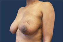 Breast Reconstruction Before Photo by Noel Natoli, MD, FACS; East Hills, NY - Case 43323