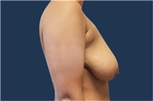 Breast Reconstruction Before Photo by Noel Natoli, MD, FACS; East Hills, NY - Case 43323