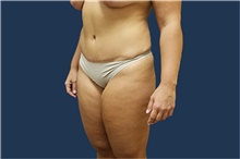 Liposuction Before Photo by Noel Natoli, MD, FACS; East Hills, NY - Case 43324