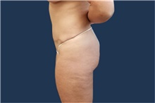 Liposuction After Photo by Noel Natoli, MD, FACS; East Hills, NY - Case 43324
