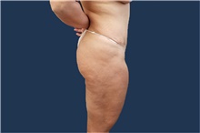 Liposuction After Photo by Noel Natoli, MD, FACS; East Hills, NY - Case 43324