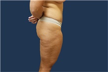 Liposuction Before Photo by Noel Natoli, MD, FACS; East Hills, NY - Case 43324