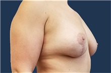 Breast Lift After Photo by Noel Natoli, MD, FACS; East Hills, NY - Case 43326