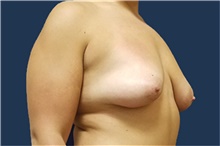 Breast Lift Before Photo by Noel Natoli, MD, FACS; East Hills, NY - Case 43326