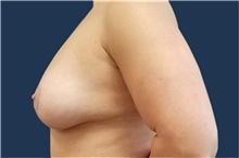 Breast Lift After Photo by Noel Natoli, MD, FACS; East Hills, NY - Case 43326