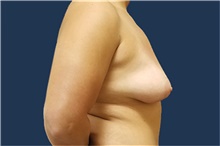 Breast Lift Before Photo by Noel Natoli, MD, FACS; East Hills, NY - Case 43326