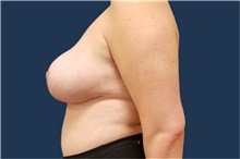 Breast Reduction After Photo by Noel Natoli, MD, FACS; East Hills, NY - Case 43329