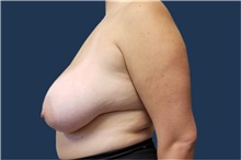 Breast Reduction Before Photo by Noel Natoli, MD, FACS; East Hills, NY - Case 43329