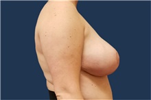 Breast Reduction After Photo by Noel Natoli, MD, FACS; East Hills, NY - Case 43329