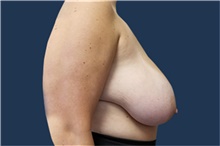 Breast Reduction Before Photo by Noel Natoli, MD, FACS; East Hills, NY - Case 43329