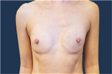 Breast Reconstruction Before Photo by Noel Natoli, MD, FACS; East Hills, NY - Case 43330