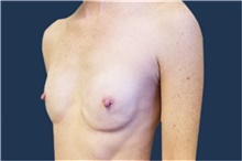 Breast Reconstruction Before Photo by Noel Natoli, MD, FACS; East Hills, NY - Case 43330