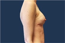 Breast Reconstruction After Photo by Noel Natoli, MD, FACS; East Hills, NY - Case 43330