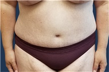 Tummy Tuck After Photo by Noel Natoli, MD, FACS; East Hills, NY - Case 43339