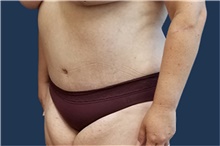 Tummy Tuck After Photo by Noel Natoli, MD, FACS; East Hills, NY - Case 43339