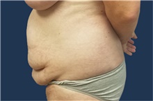Tummy Tuck Before Photo by Noel Natoli, MD, FACS; East Hills, NY - Case 43339