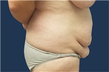 Tummy Tuck Before Photo by Noel Natoli, MD, FACS; East Hills, NY - Case 43339