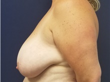 Breast Reduction Before Photo by Noel Natoli, MD, FACS; East Hills, NY - Case 43340