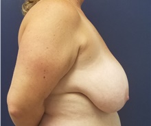 Breast Reduction Before Photo by Noel Natoli, MD, FACS; East Hills, NY - Case 43340