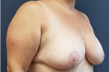 Breast Reduction After Photo by Noel Natoli, MD, FACS; East Hills, NY - Case 43340