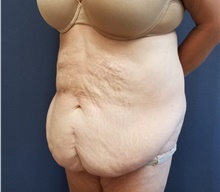 Tummy Tuck Before Photo by Noel Natoli, MD, FACS; East Hills, NY - Case 43341