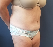 Tummy Tuck After Photo by Noel Natoli, MD, FACS; East Hills, NY - Case 43341