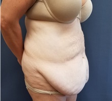 Tummy Tuck Before Photo by Noel Natoli, MD, FACS; East Hills, NY - Case 43341