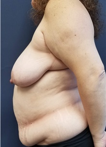 Tummy Tuck Before Photo by Noel Natoli, MD, FACS; East Hills, NY - Case 43343
