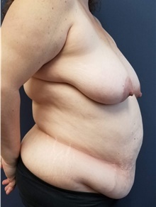 Tummy Tuck Before Photo by Noel Natoli, MD, FACS; East Hills, NY - Case 43343