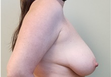 Breast Reduction Before Photo by Noel Natoli, MD, FACS; East Hills, NY - Case 43345