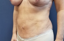 Liposuction After Photo by Noel Natoli, MD, FACS; East Hills, NY - Case 43346