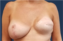 Breast Reconstruction Before Photo by Noel Natoli, MD, FACS; East Hills, NY - Case 43347