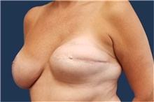 Breast Reconstruction Before Photo by Noel Natoli, MD, FACS; East Hills, NY - Case 43347