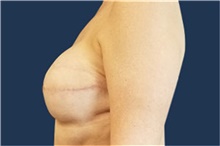 Breast Reconstruction After Photo by Noel Natoli, MD, FACS; East Hills, NY - Case 43347