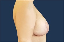 Breast Reconstruction After Photo by Noel Natoli, MD, FACS; East Hills, NY - Case 43347