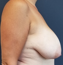 Breast Reduction Before Photo by Noel Natoli, MD, FACS; East Hills, NY - Case 43349