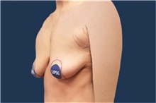 Breast Augmentation Before Photo by Noel Natoli, MD, FACS; East Hills, NY - Case 43350