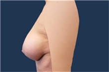 Breast Augmentation After Photo by Noel Natoli, MD, FACS; East Hills, NY - Case 43350