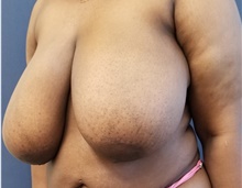 Breast Reduction Before Photo by Noel Natoli, MD, FACS; East Hills, NY - Case 43354