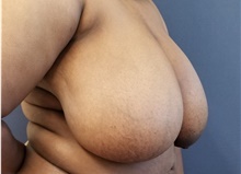Breast Reduction Before Photo by Noel Natoli, MD, FACS; East Hills, NY - Case 43354
