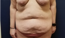 Tummy Tuck Before Photo by Noel Natoli, MD, FACS; East Hills, NY - Case 43358